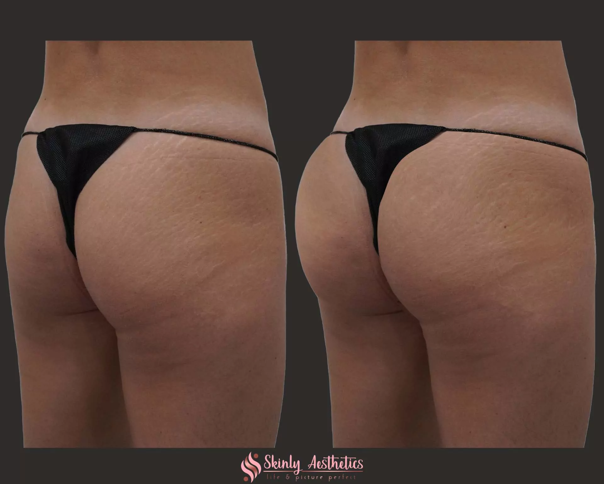 Sculptra buttocks augmentation