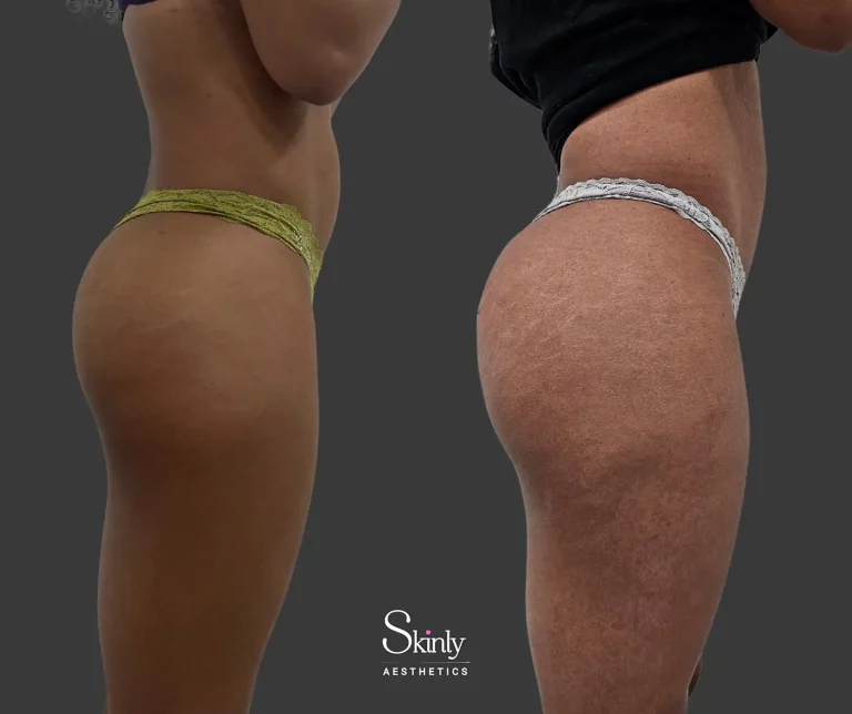 Side profile results after customized Liquid Butt Lift in NYC