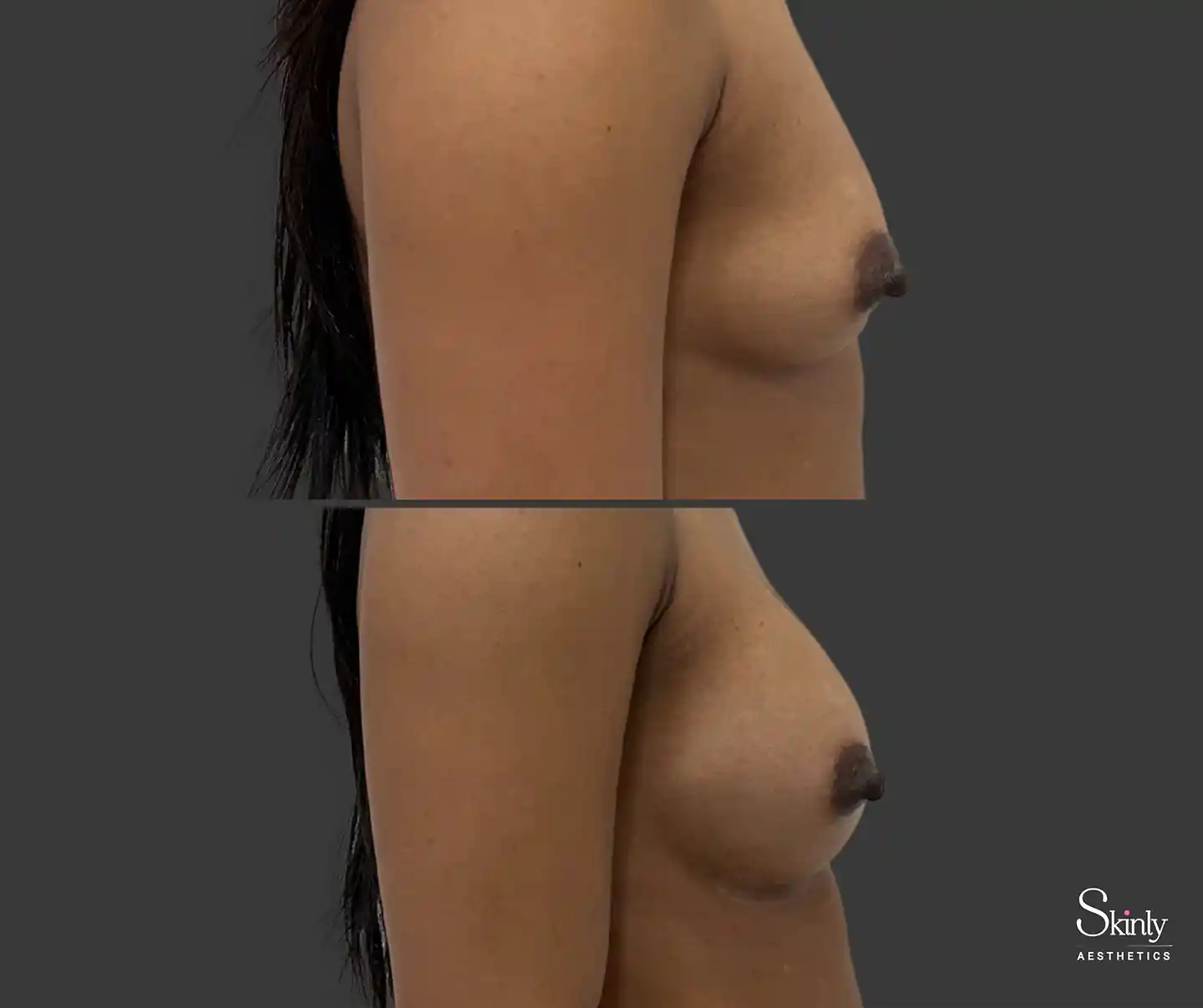 Side profile before-and-after non-surgical breast enhancement