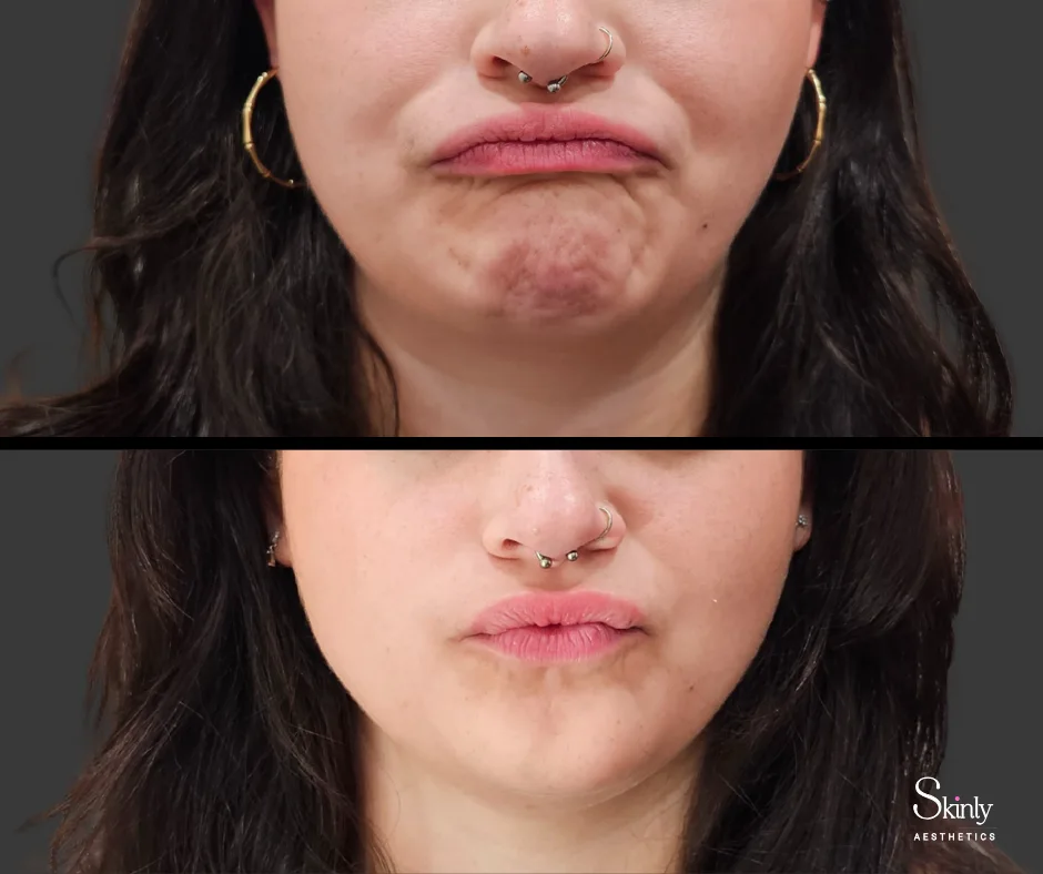 Before and after results chin Botox to smooth dimpling.