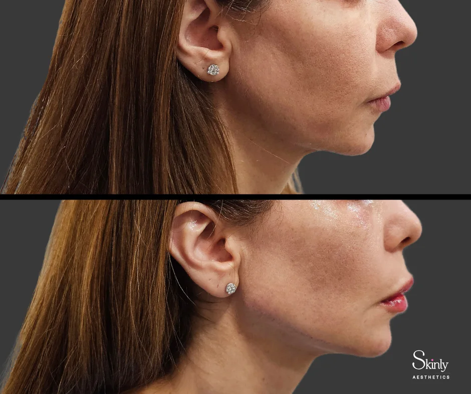 Before and after results showcasing jawline lifting with dermal fillers