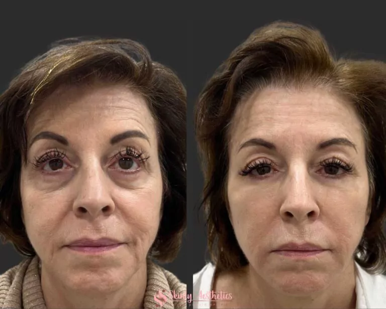 under eye circles treatment Juvederm filler