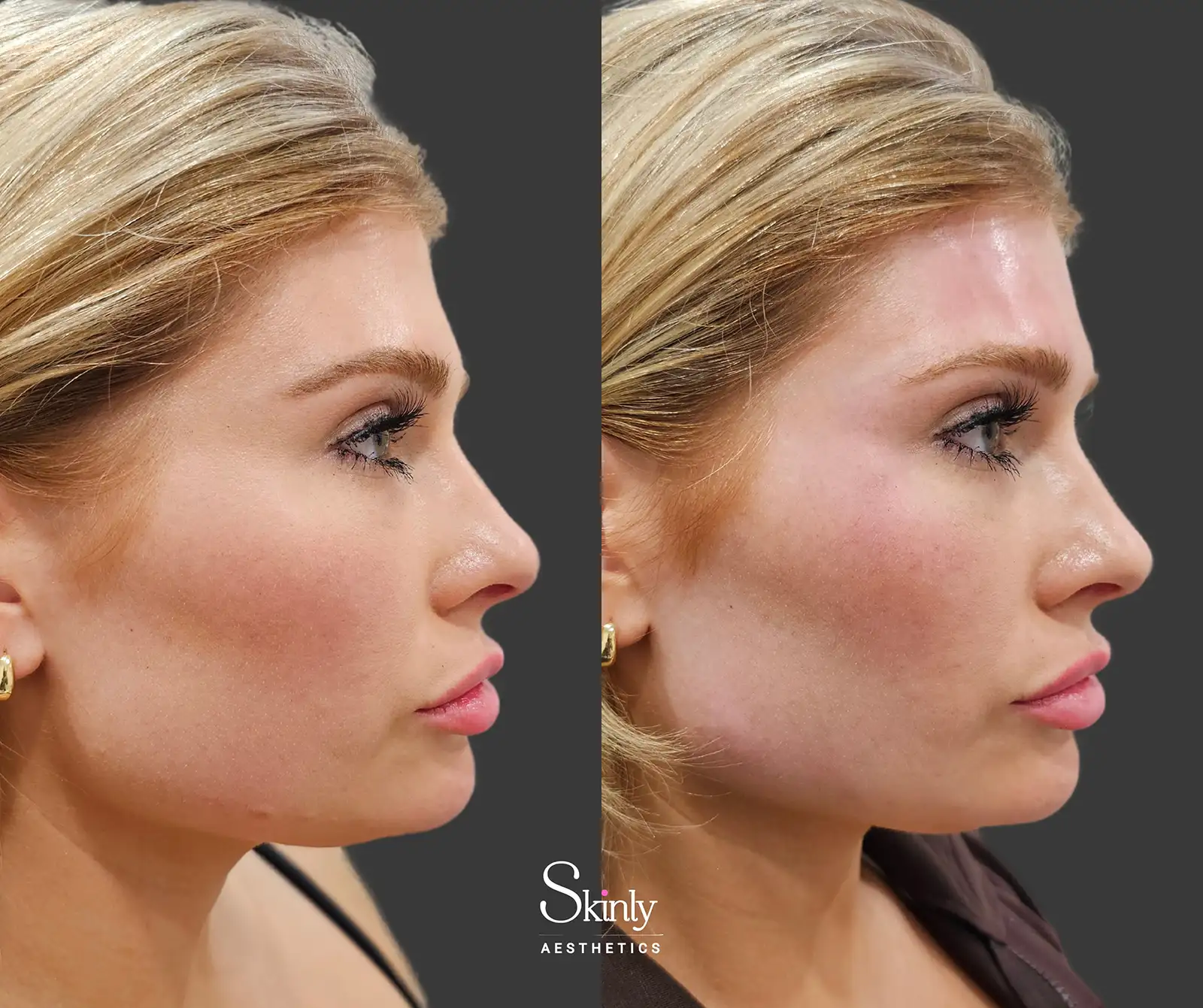 Before and after forehead filler side view demonstrating subtle volume restoration and balanced brow transition