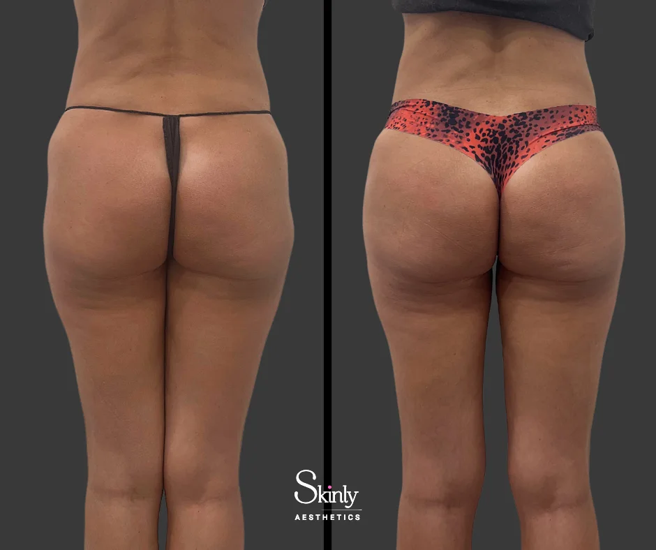Before and after liquid hip dip correction showing balanced hips.