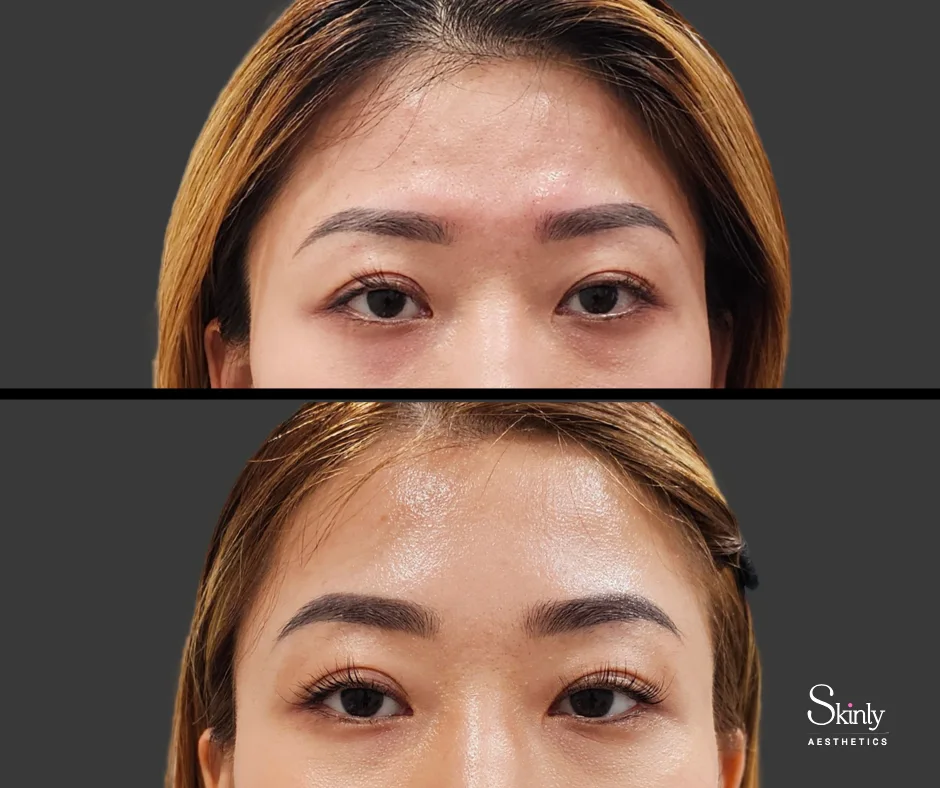 Before and after forehead filler, showing rejuvenated forehead.