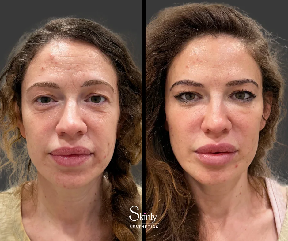 Before and after forehead filler showing reduced deep static wrinkles.