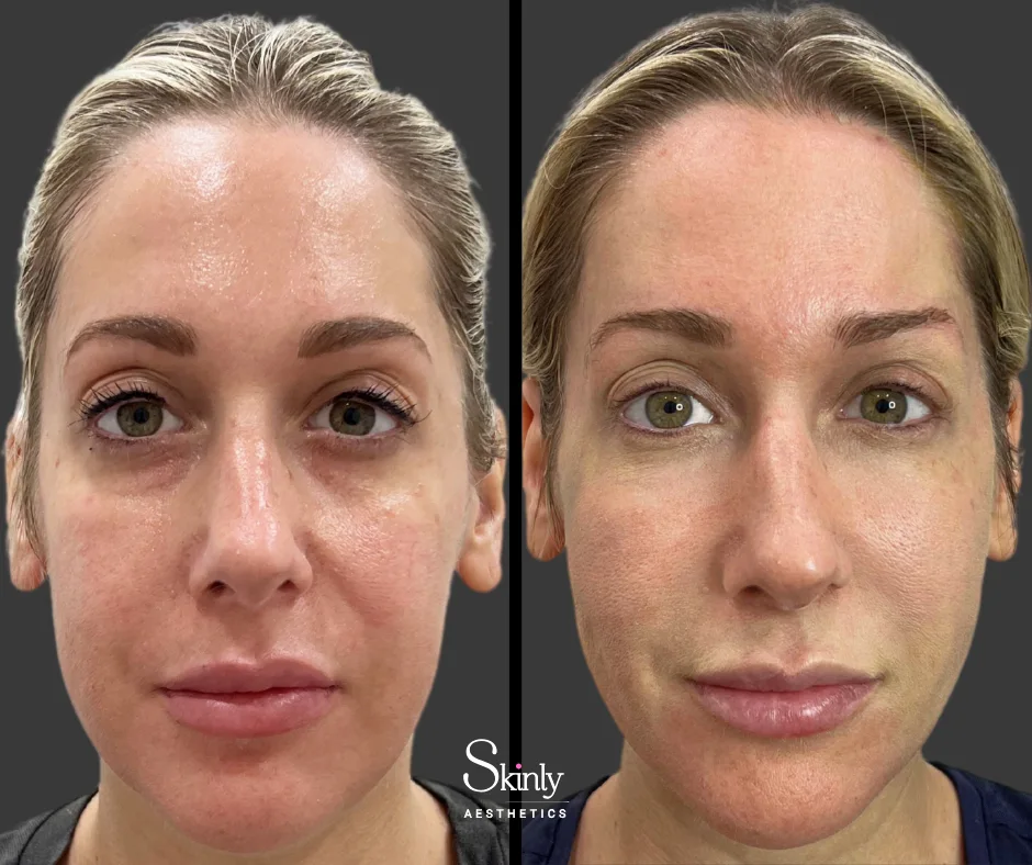 Before and after cheek augmentation with filler, showing enhanced structure.