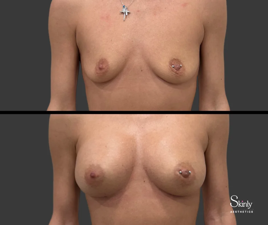 Liquid breast lift before and after, showing fuller breasts.