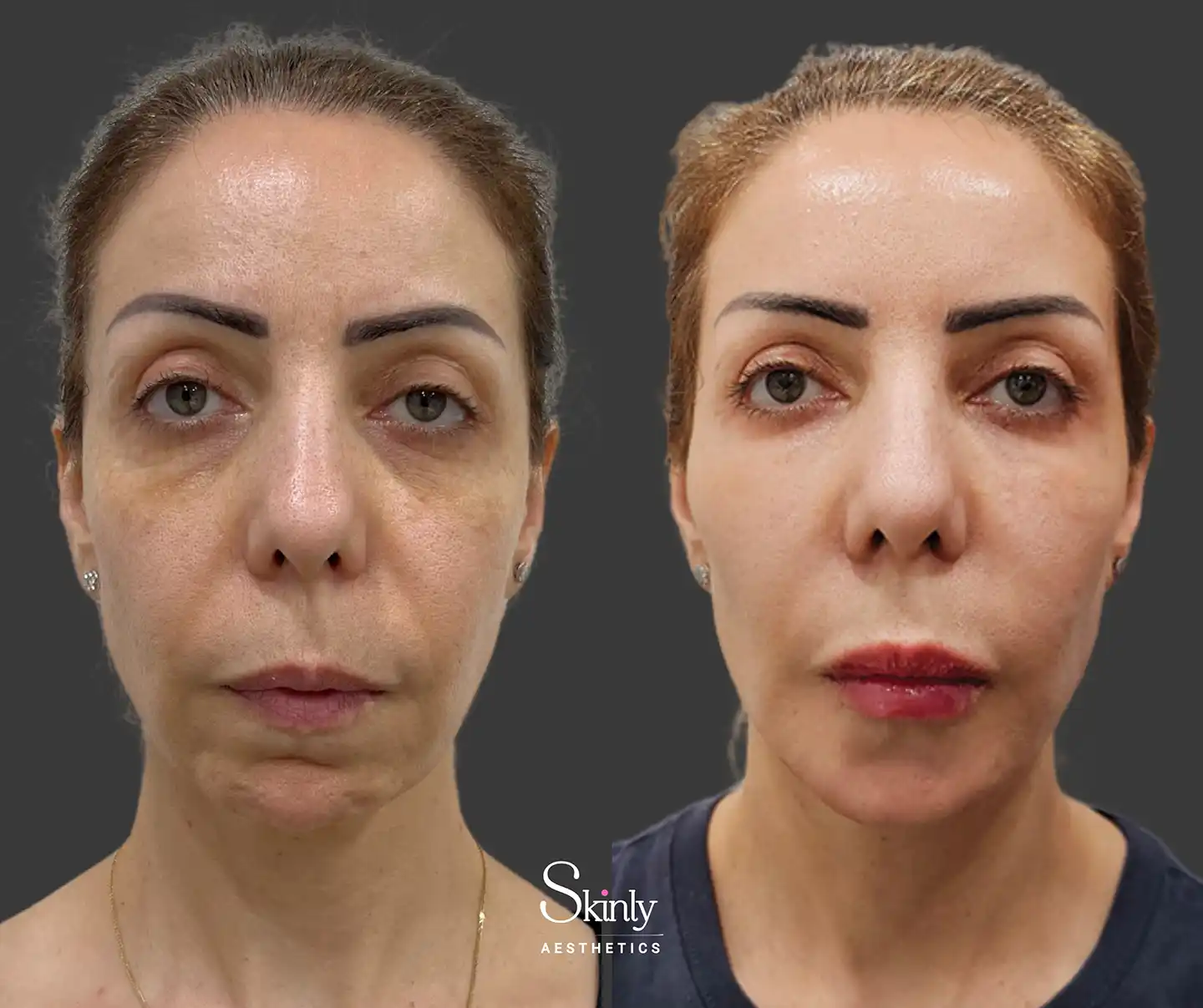 Front image showing rejuvenated under-eye fullness, smoother lips, and restored facial volume after liquid facelift
