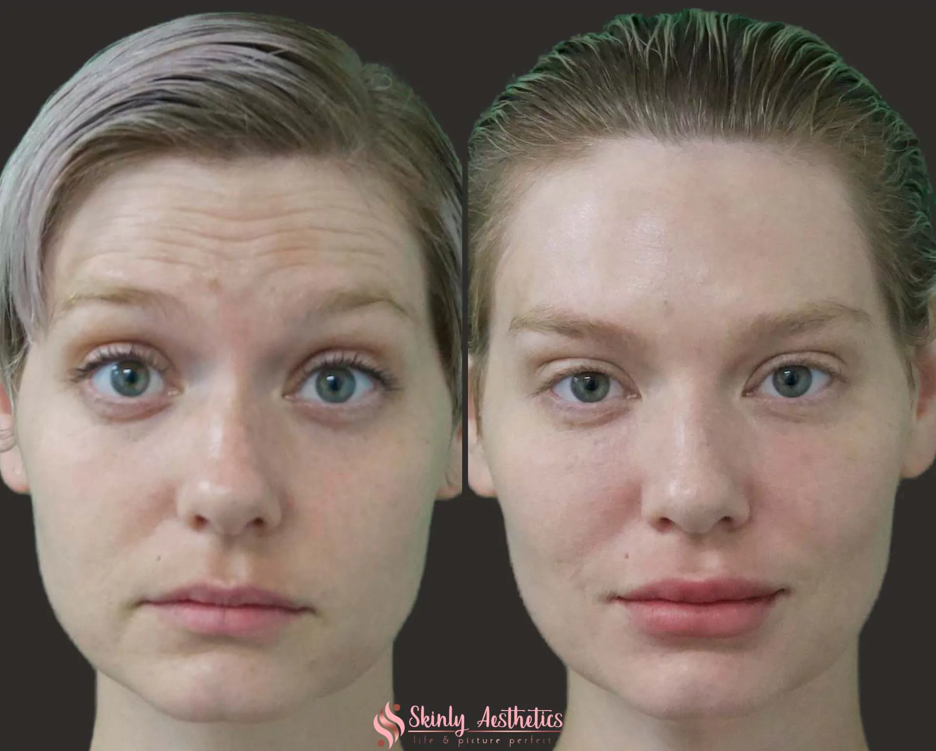 non surgical botox brow lift procedure