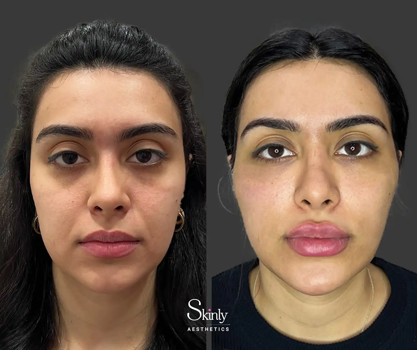 Front view of complete facial rejuvenation including smoother skin, lifted brows, fuller lips, and refreshed eyes after liquid facelift
