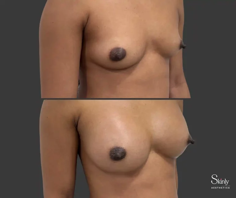 Side profile breast lift results correcting sagging