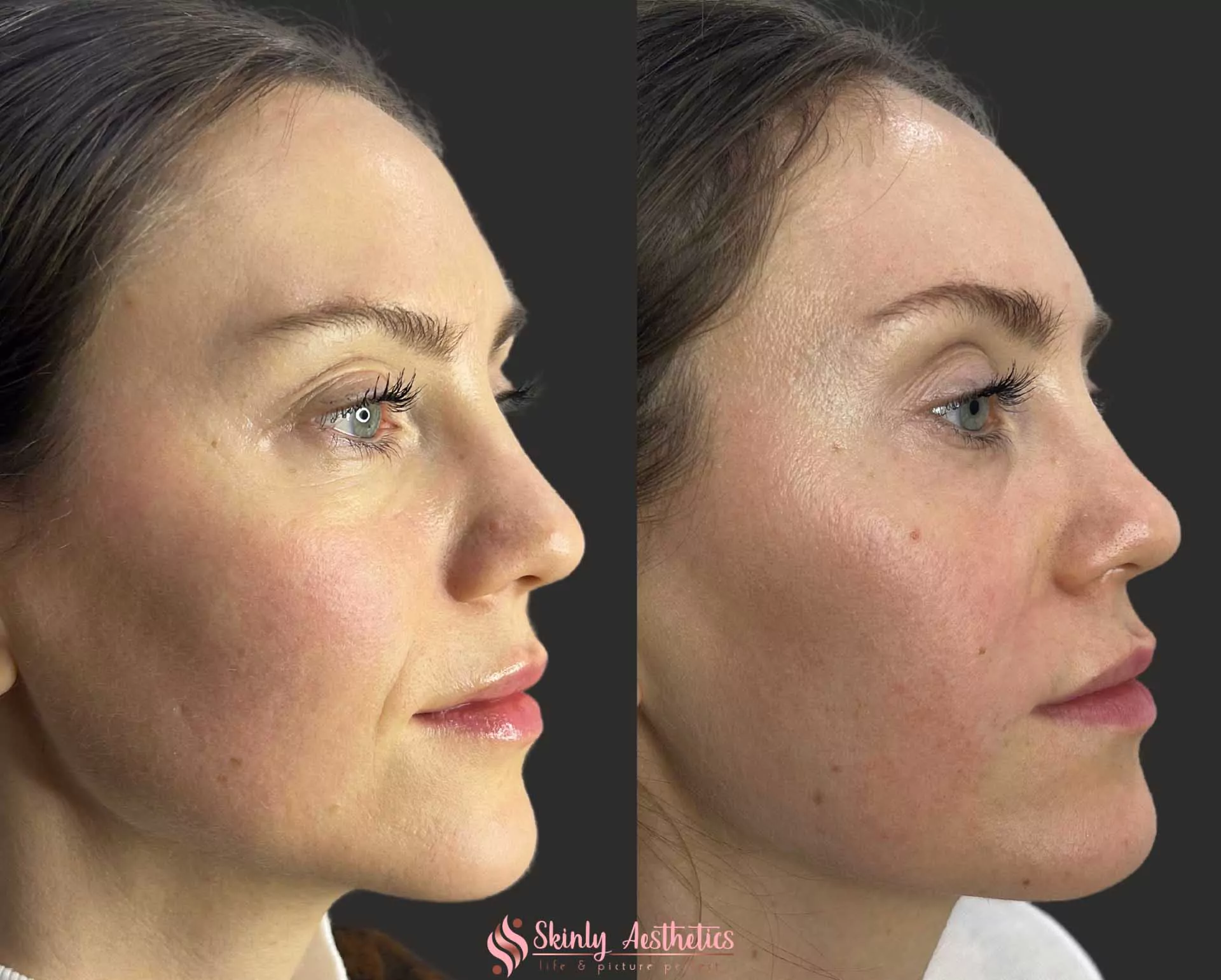 smile lines injections Juvederm Ultra filler