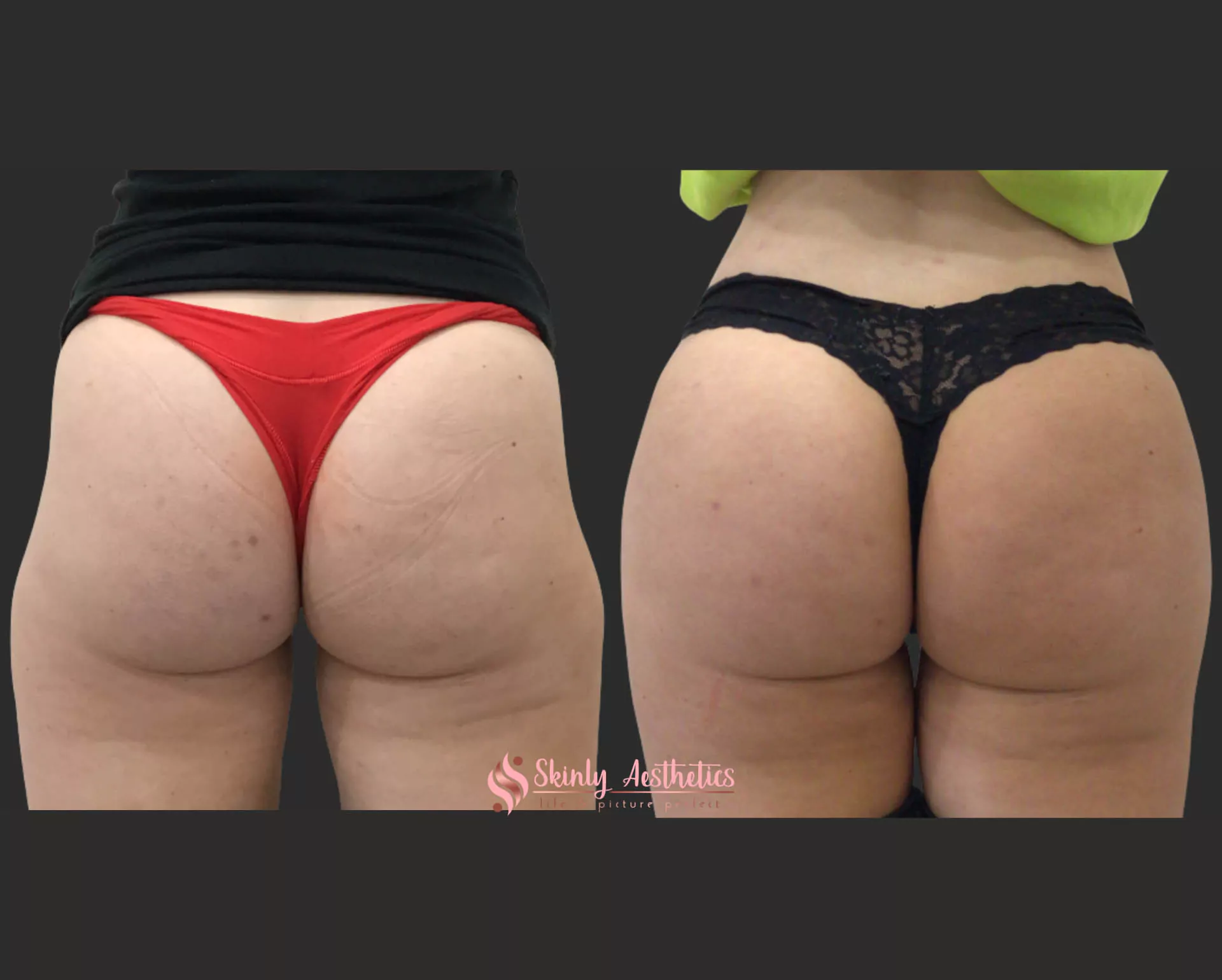 sculptra bbl