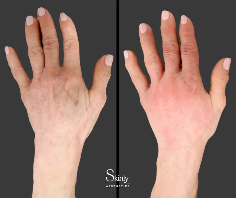 Hand filler before and after plumping results
