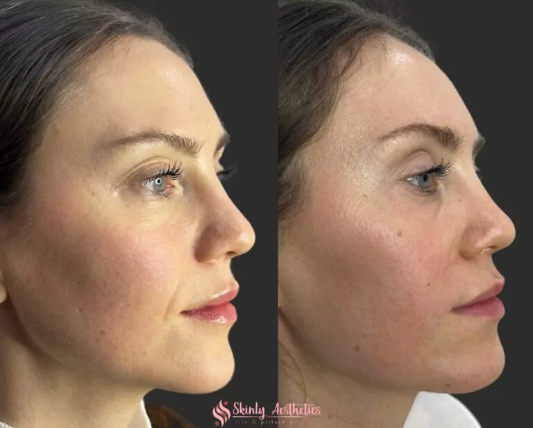 smile lines injections Juvederm Ultra filler