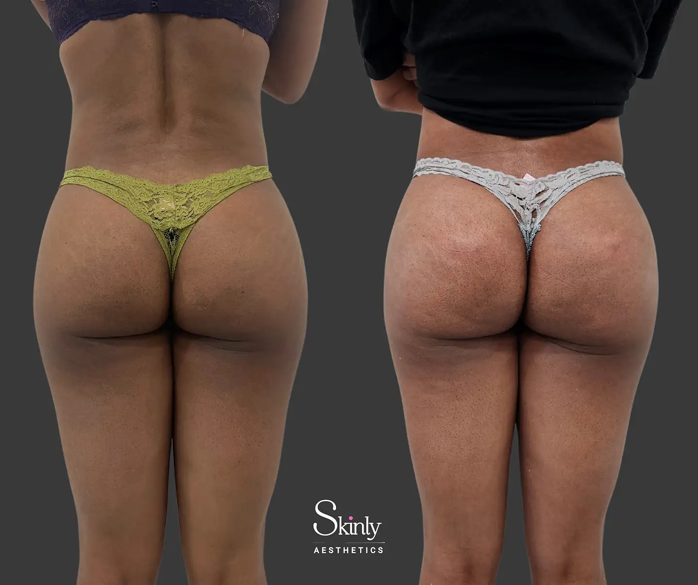 Sculptra-based liquid butt lift results from back-side view