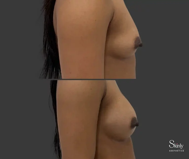 Side profile before-and-after non-surgical breast enhancement