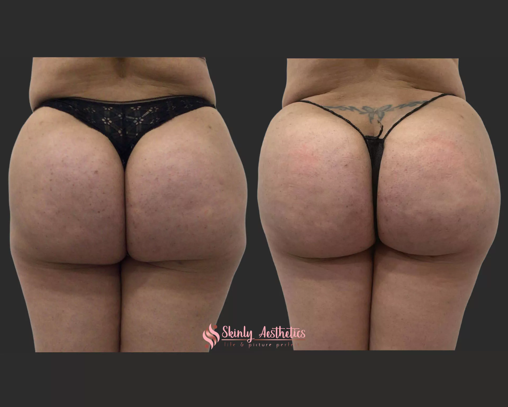 sculptra filler buttocks injections
