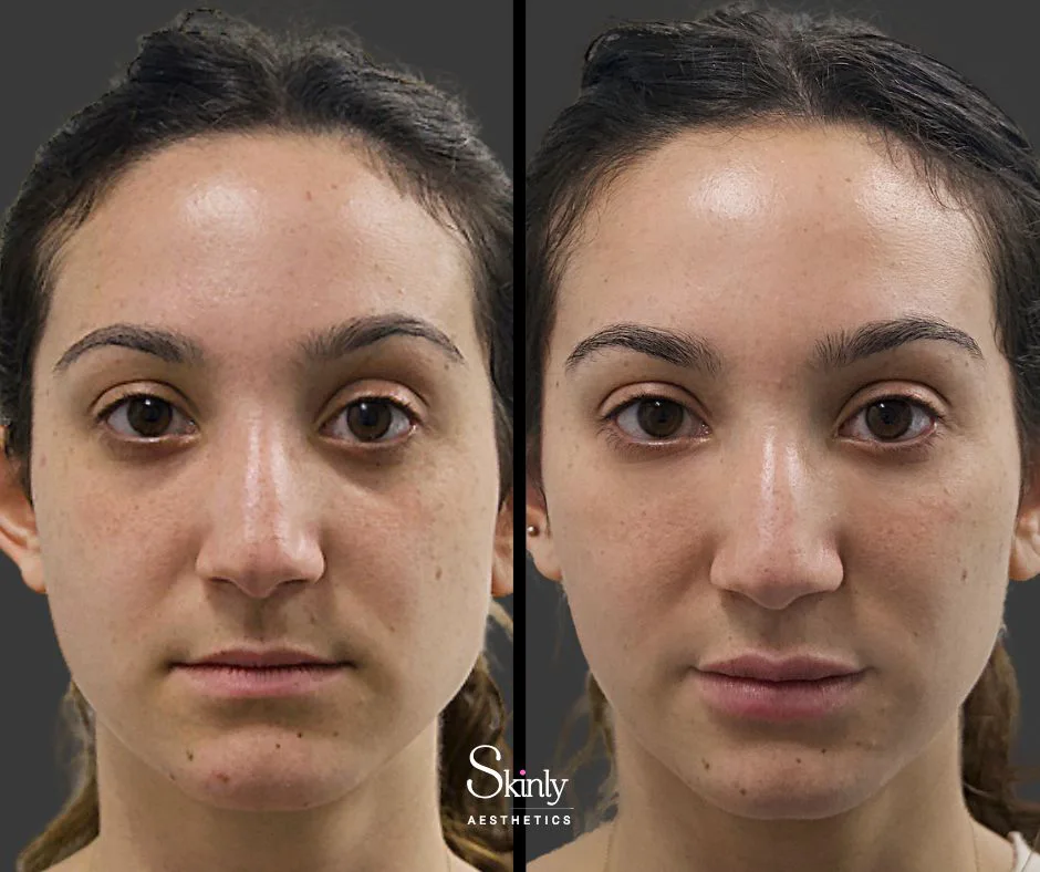 Before and after under eye rejuvenation with filler.