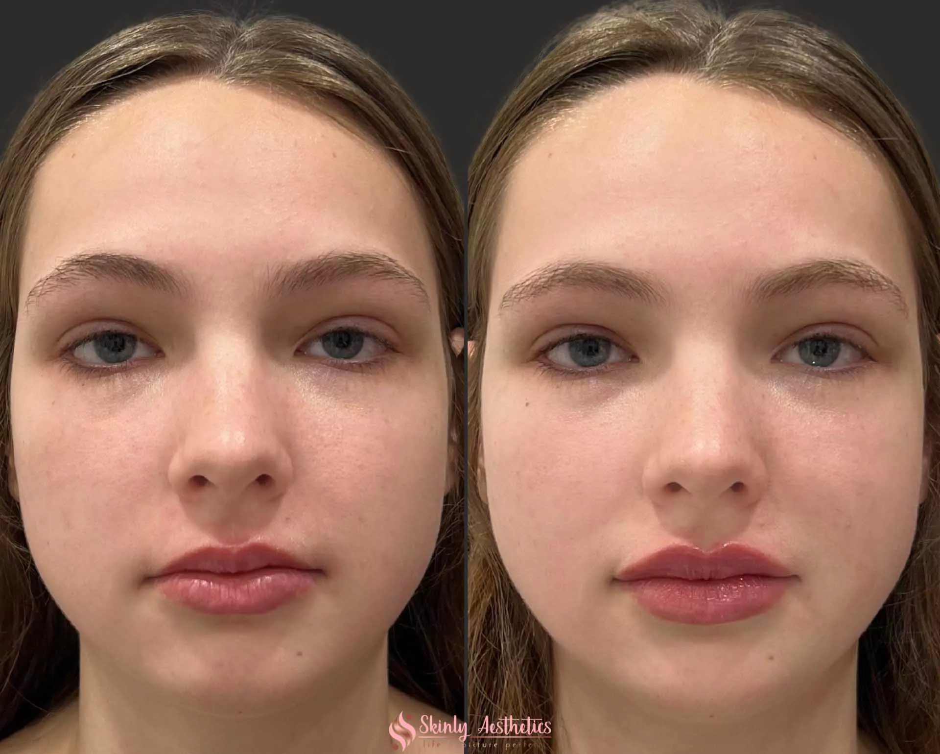 lip filler procedure with Juvederm Ultra