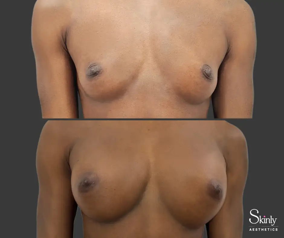Front-view image illustrating lifted, fuller breasts following treatment at Skinly Aesthetics NYC