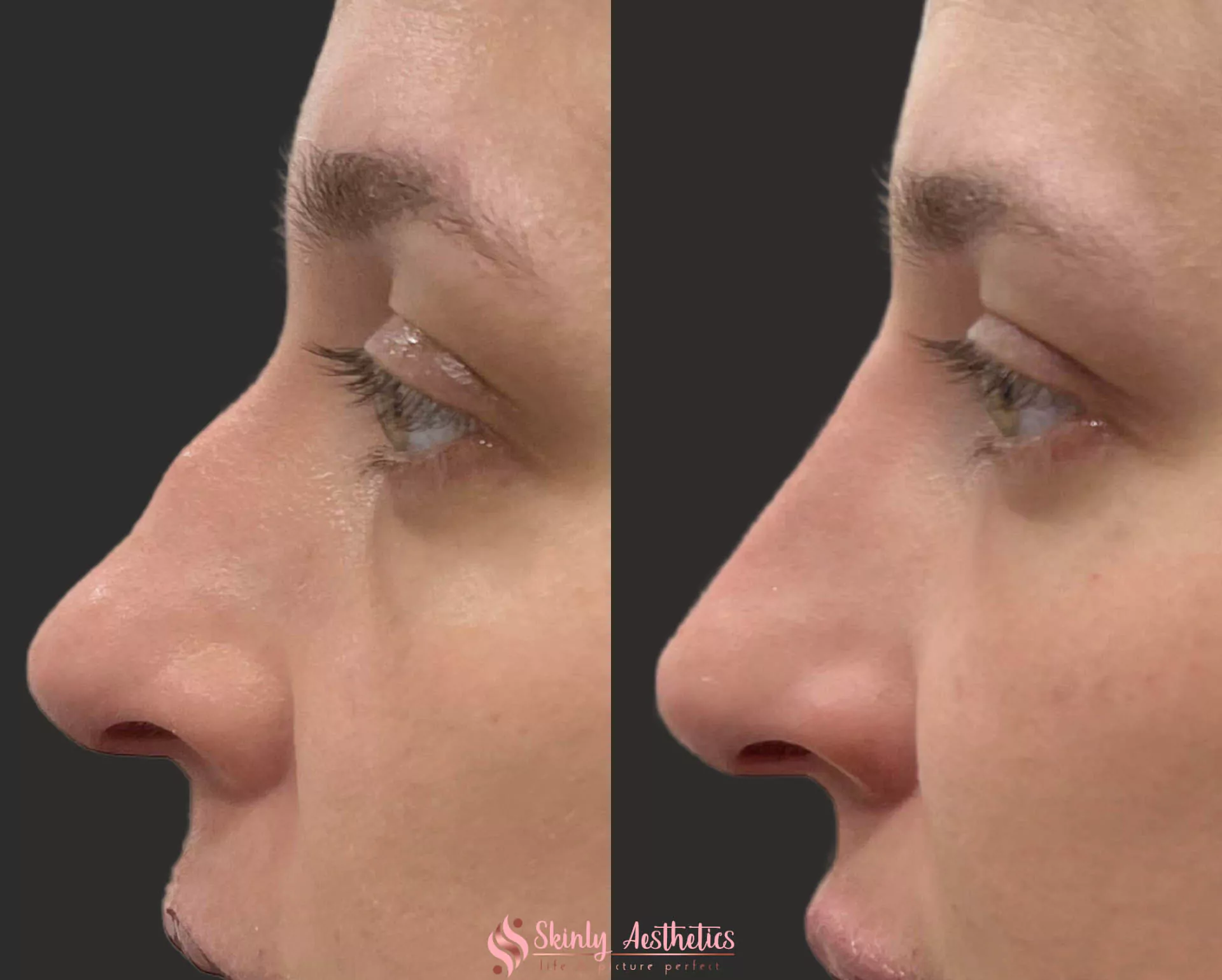 liquid rhinoplasty results after 1 syringe of Juvederm Voluma