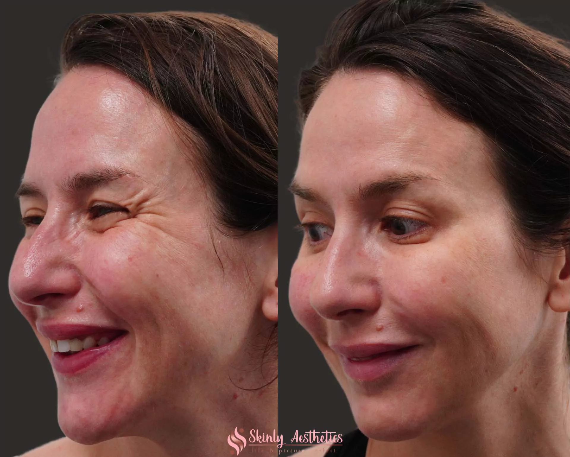 crows feet reduction with botox
