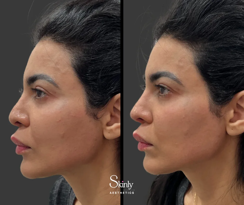 Before and after liquid rhinoplasty, showing a straighter, more defined profile.