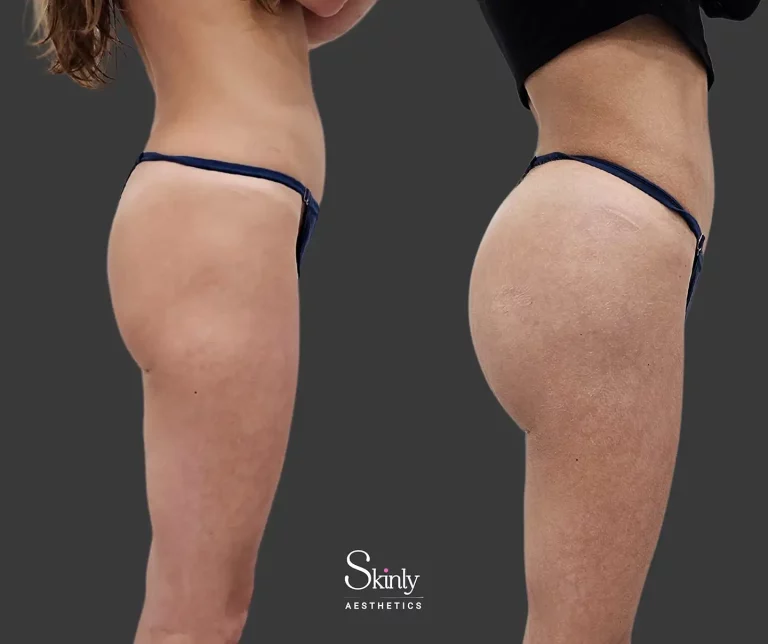 Side angle of buttock enhancement using Hyaluronic Acid dermal filler