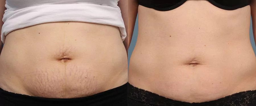 before and after results of treating stretch marks with Ultherapy before and after results of treating stretch marks with Ultherapy