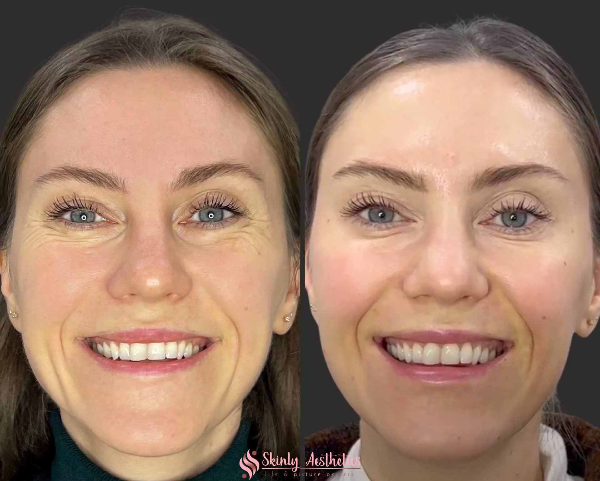 crows feet reduction with 20 units of Botox