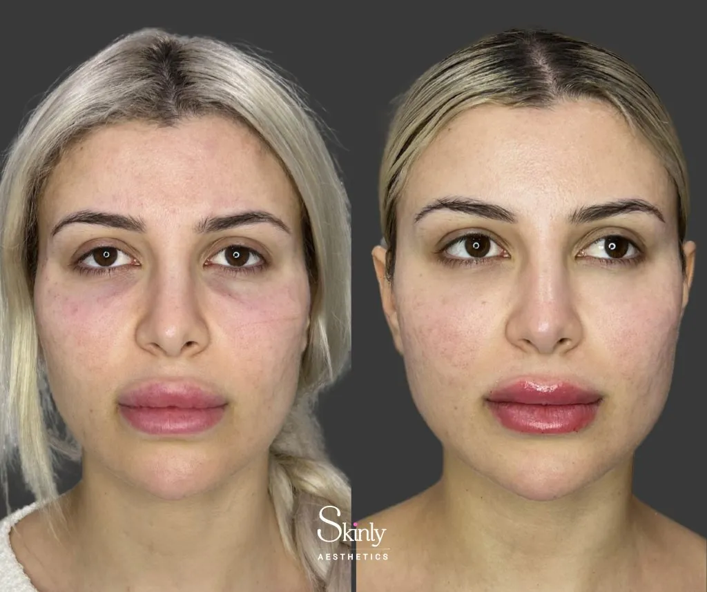 Natural under eye filler before and after results