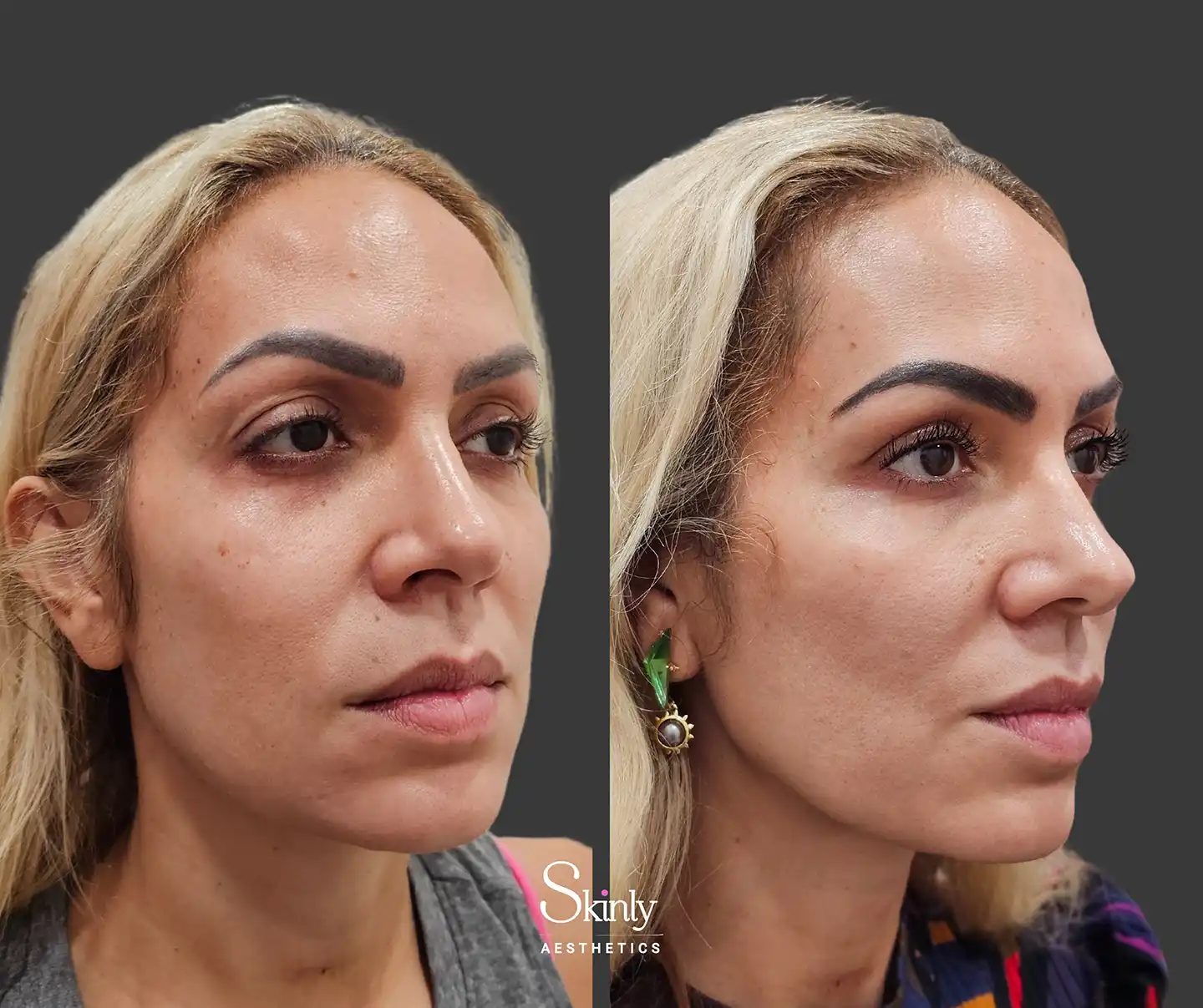 Side-profile before and after Liquid Facelift showing lifted eyebrows, rejuvenated lips, reduced nasolabial folds, and refreshed under-eye area