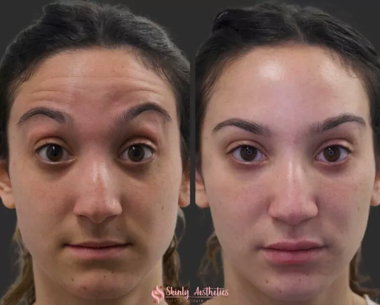 Botox forehead wrinkles