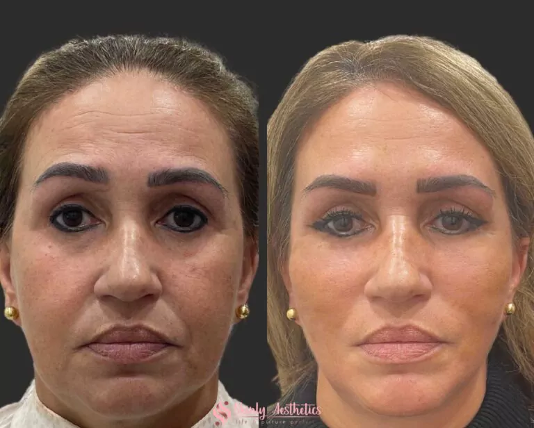 PDO threads for V shaped facelift without surgery