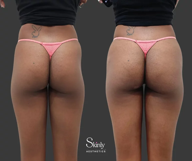 Liquid Butt Lift using filler shown from diagonal back angle