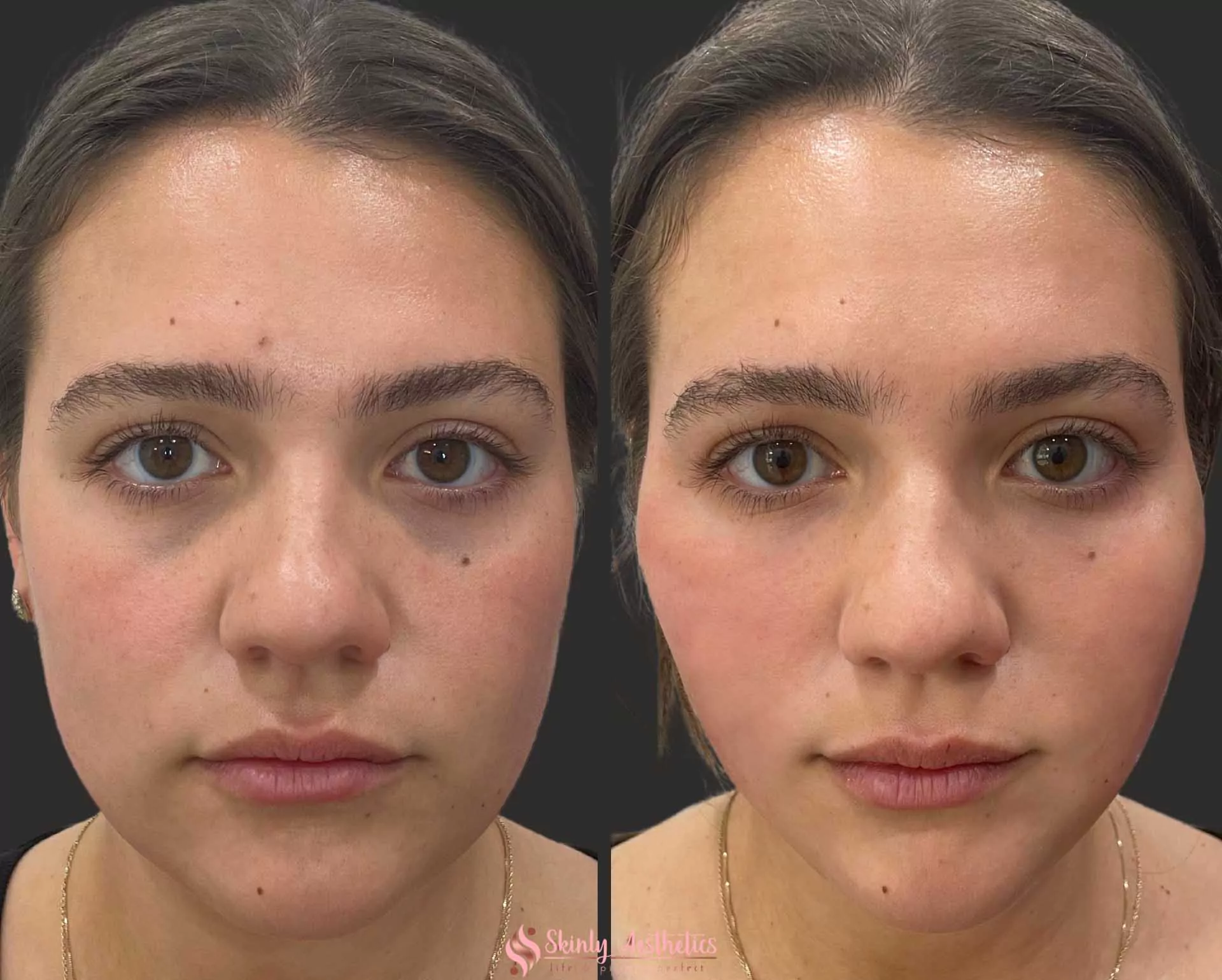 non surgical facelift and tightening with PDO threads