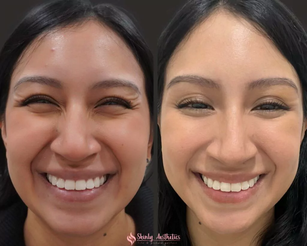 results showing complete elimination of periorbital Crows feet after injecting 20 units of Botox