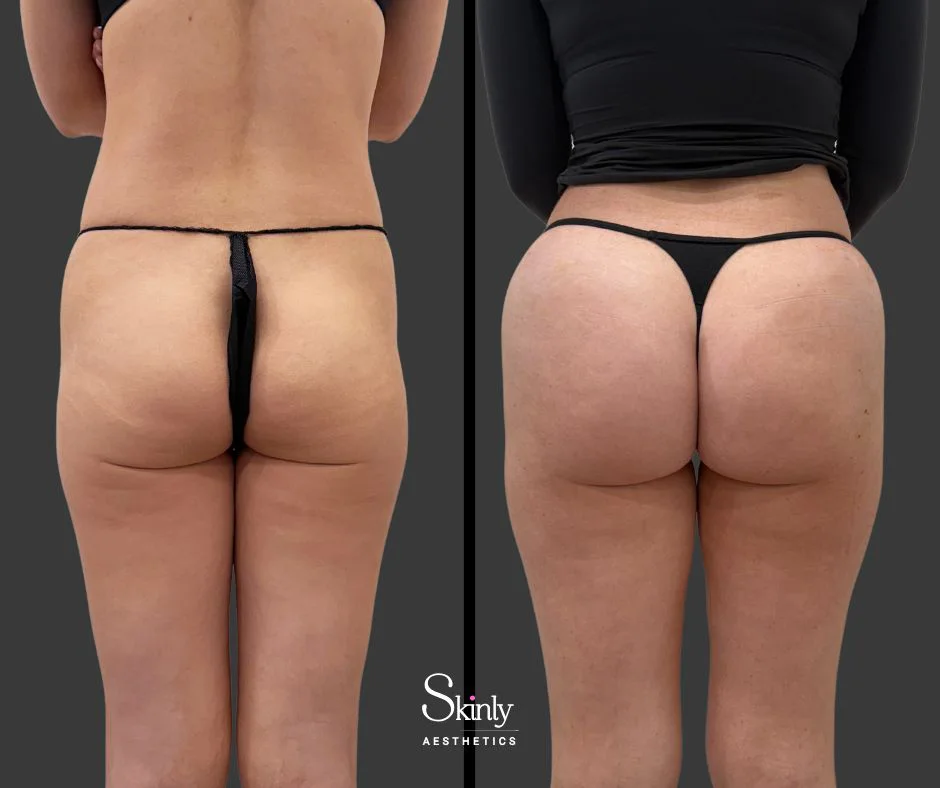 Before and after liquid butt enhancement showing improved curves.