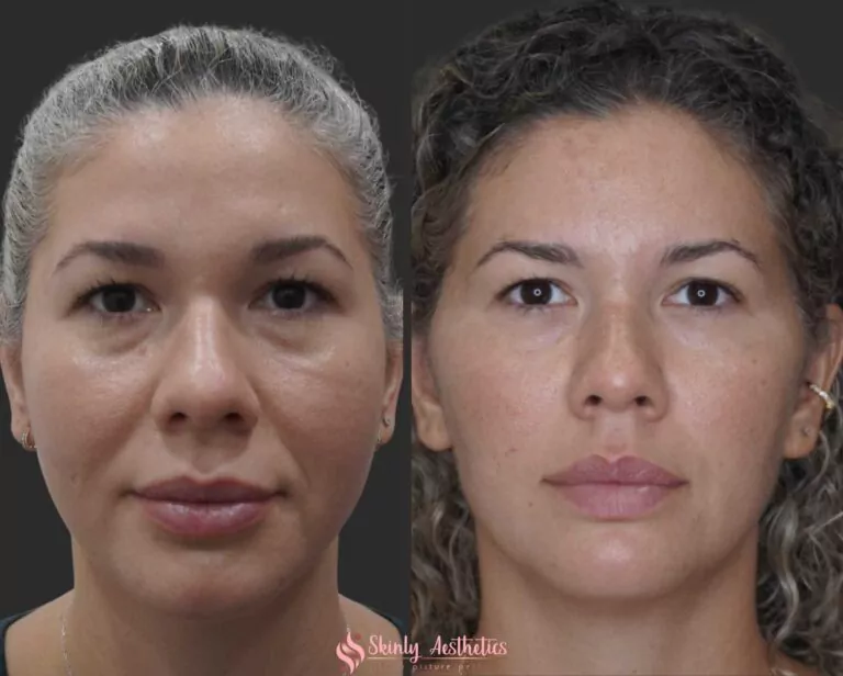 non surgical PDO thread lift results