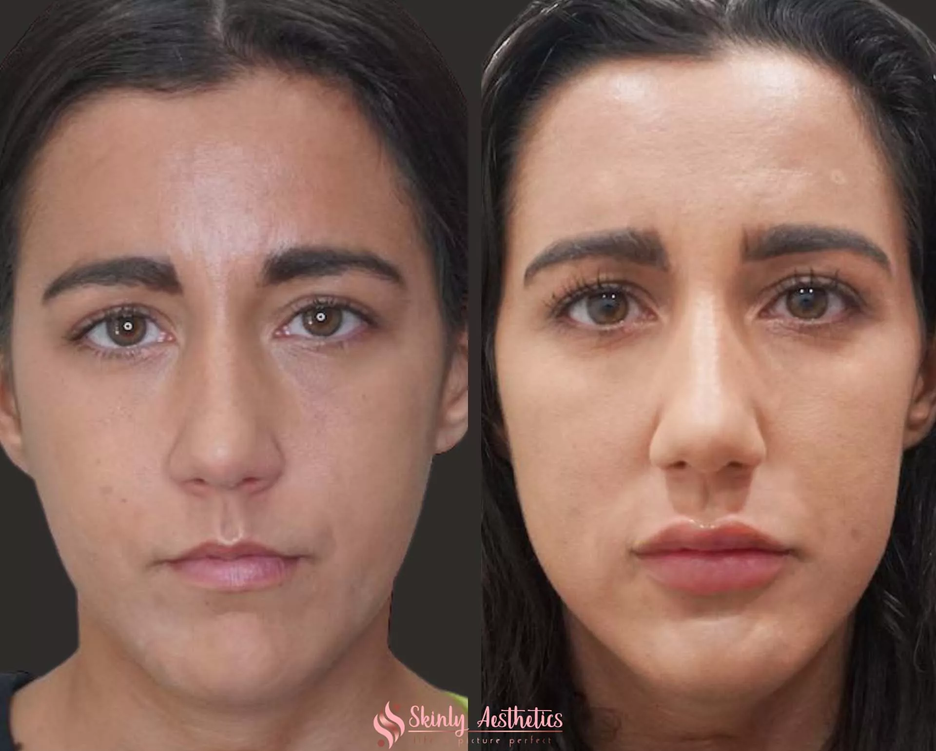 restylane lip filler augmentation