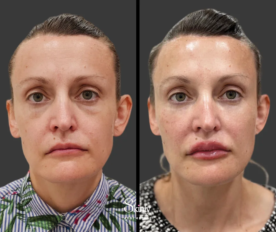 Before and after cheek filler, showing balanced facial contours.