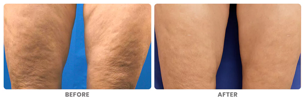 before and after results of radiofrequency microneedling for cellulite on legs Before and after results radiofrequency microneedling for cellulite on legs