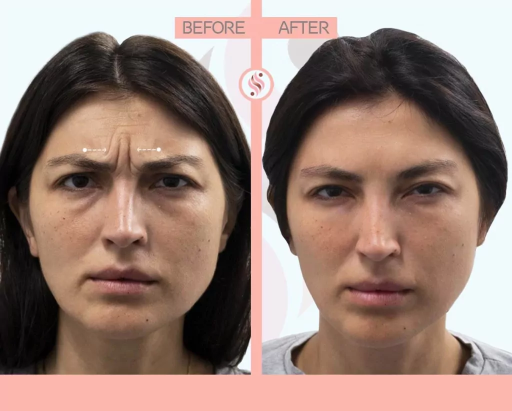 dysport before after photo