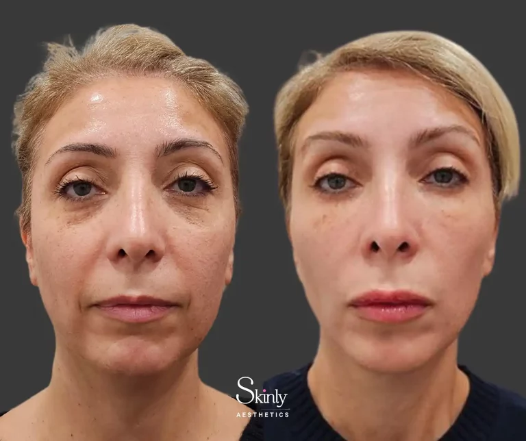 Front view demonstrating lifted eyebrows and rejuvenated midface after liquid facelift