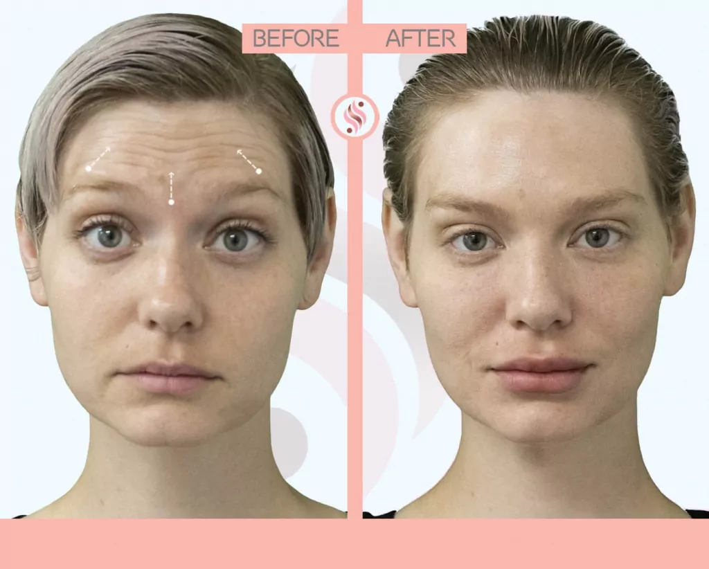 dysport before after