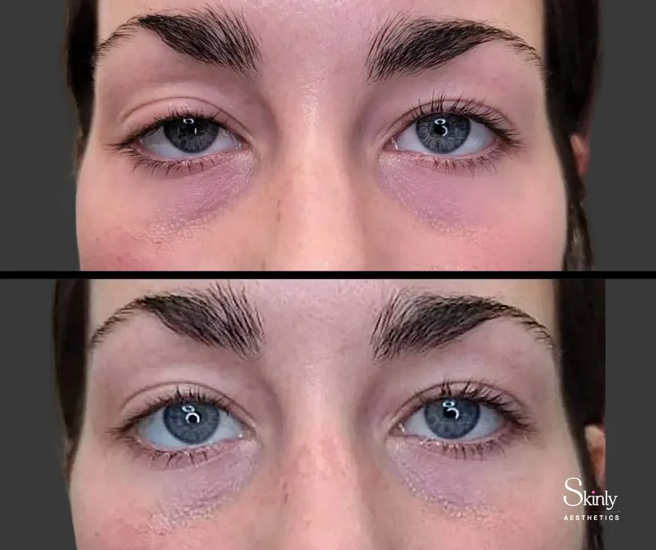 Upneeq for lazy eyes before and after, showing balanced eye symmetry.