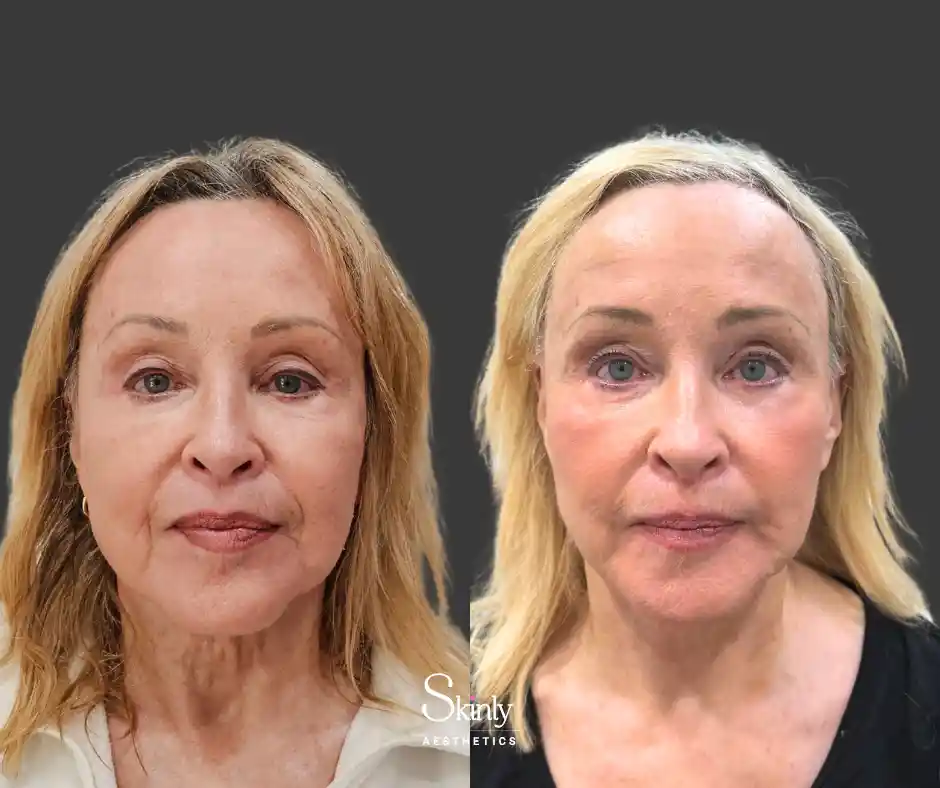 Skin rejuvenation results after CO2 laser