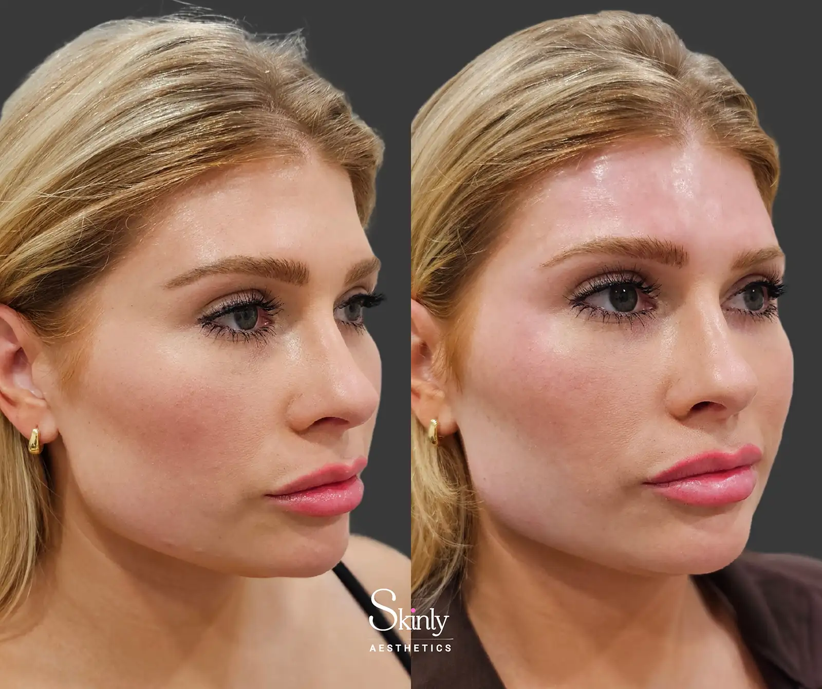 Side view before and after forehead filler correcting hollow areas for improved symmetry